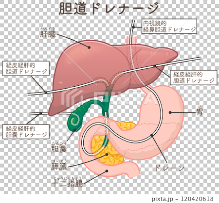 胆道ドレナージのイラスト、Biliary Drainage 胆道ドレナージのイラスト、Biliary Drainage 120420618