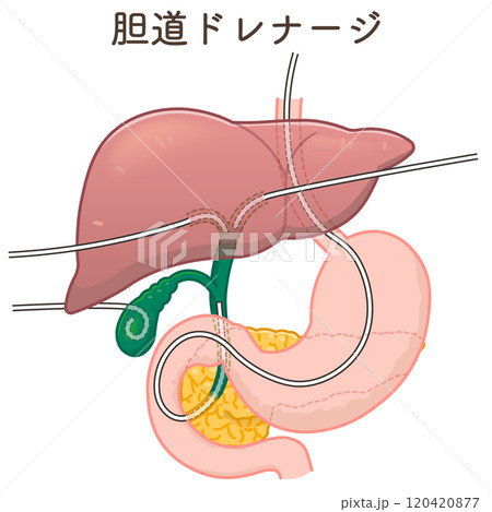 胆道ドレナージのイラスト、Biliary Drainage 120420877