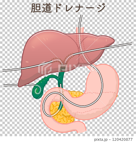 胆道ドレナージのイラスト、Biliary Drainage 120420877