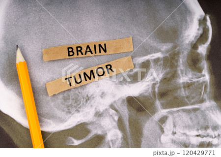 On x-rays of a human skull, a pencil and strips of paper with the inscription - Brain tumor 120429771