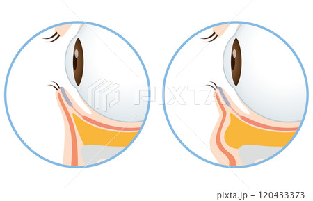 目の下のたるみ たるみのない目元と、たるんだ目元 目の下のたるみ たるみのない目元と、たるんだ目元 120433373