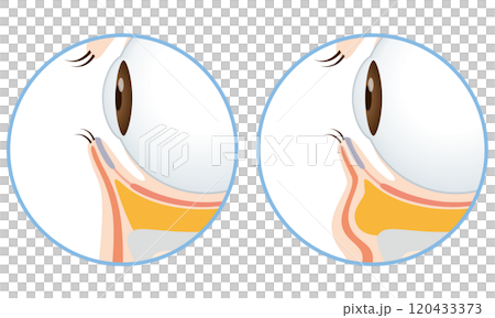 目の下のたるみ たるみのない目元と、たるんだ目元 目の下のたるみ たるみのない目元と、たるんだ目元 120433373