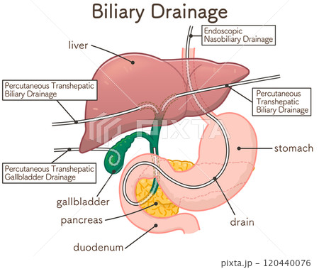 胆道ドレナージのイラスト、Biliary Drainage 120440076