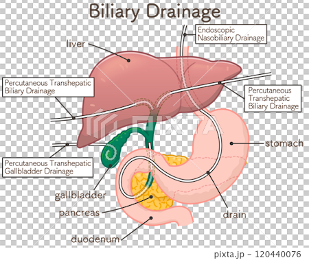 胆道ドレナージのイラスト、Biliary Drainage 120440076