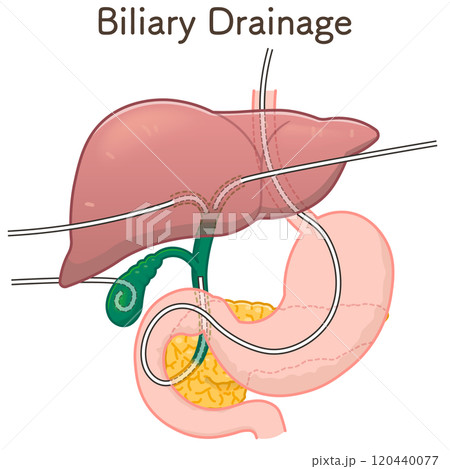 胆道ドレナージのイラスト、Biliary Drainage 120440077