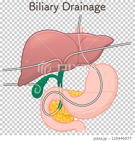 胆道ドレナージのイラスト、Biliary Drainage 120440077