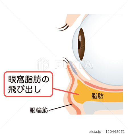 目の下のたるみ　たるんだ下まぶた 120448071