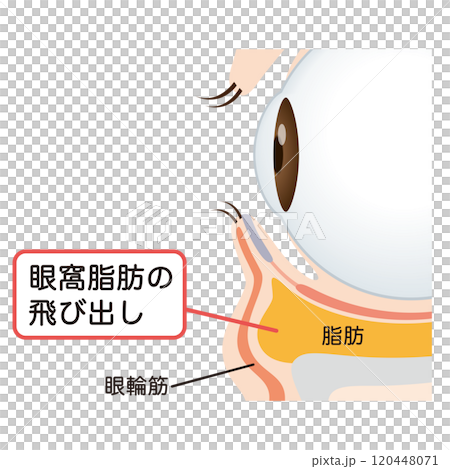 目の下のたるみ　たるんだ下まぶた 120448071