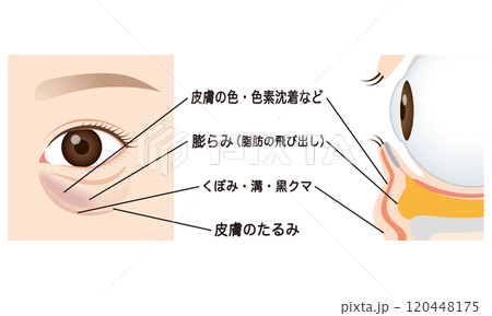 目の下のたるみ たるんだ下まぶた 目の下のたるみ たるんだ下まぶた 120448175