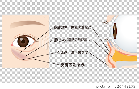 Bags under the eyes, sagging lower eyelids 120448175