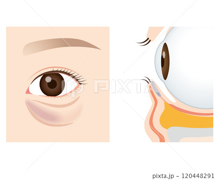目の下のたるみ たるんだ下まぶた 目の下のたるみ たるんだ下まぶた 120448291