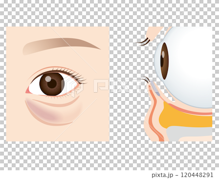 目の下のたるみ たるんだ下まぶた 目の下のたるみ たるんだ下まぶた 120448291