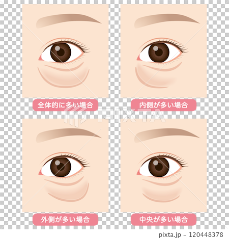 眼袋、下眼瞼下垂型 眼袋、下眼瞼下垂型 120448378