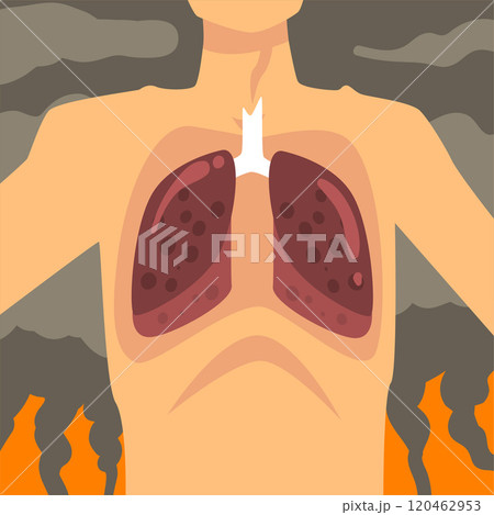 Human Lungs, People Suffering from Industrial Smog, Respiratory Disease from Industry Air Pollution, Vector Illustration Human Lungs, People Suffering from Industrial Smog, Respiratory Disease from Industry Air Pollution, Vector Illustration 120462953
