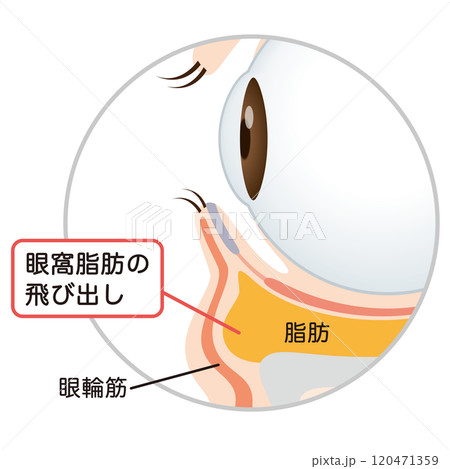 目の下のたるみ たるんだ下まぶた 目の下のたるみ たるんだ下まぶた 120471359