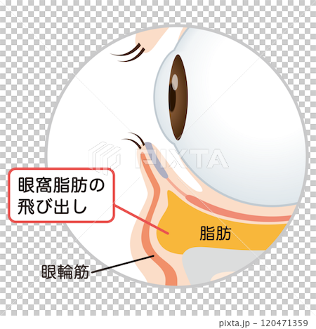 眼袋、下眼瞼下垂 120471359