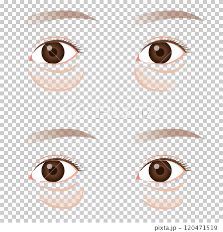 Sagging under the eyes, sagging lower eyelid type Sagging under the eyes, sagging lower eyelid type 120471519