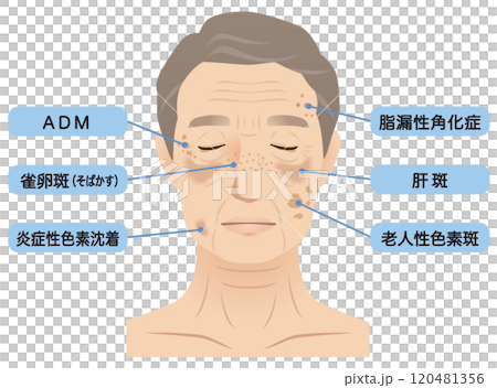 高齢男性の顔　シミ　名称　美容　老化 120481356