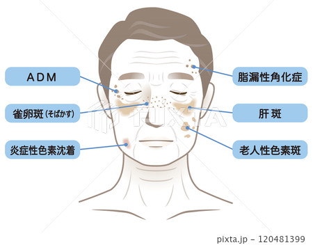 高齢男性の顔　シミ　名称　美容　老化 120481399