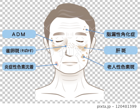 高齢男性の顔　シミ　名称　美容　老化 120481399