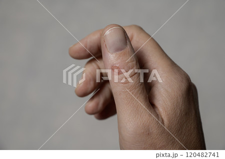 there is a fresh wound on the thumb 120482741