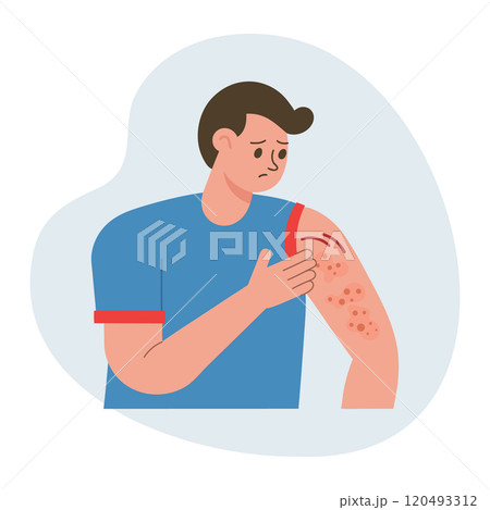 Man scratching his hand. Allergic itching, skin inflammation, redness and irritation. Atopic dermatitis, eczema, psoriasis. Healthcare and medicine. Man scratching his hand. Allergic itching, skin inflammation, redness and irritation. Atopic dermatitis, eczema, psoriasis. Healthcare and medicine. 120493312