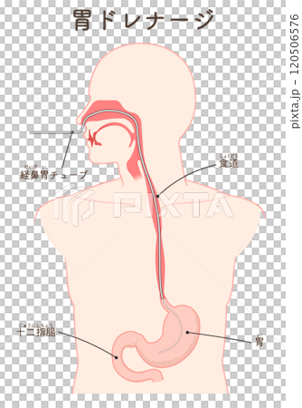 胃ドレナージ、Nasogastric tube 胃ドレナージ、Nasogastric tube 120506576