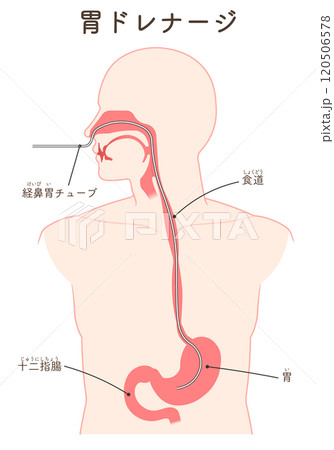 胃ドレナージ、Nasogastric tube 胃ドレナージ、Nasogastric tube 120506578
