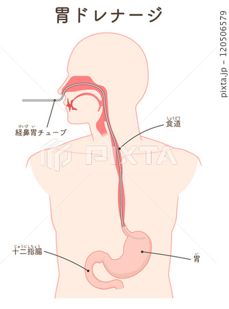 胃ドレナージ、Nasogastric tube 120506579