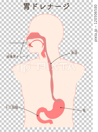 Gastric drainage, nasogastric tube Gastric drainage, nasogastric tube 120506580