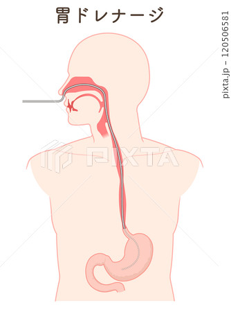 胃ドレナージ、Nasogastric tube 120506581