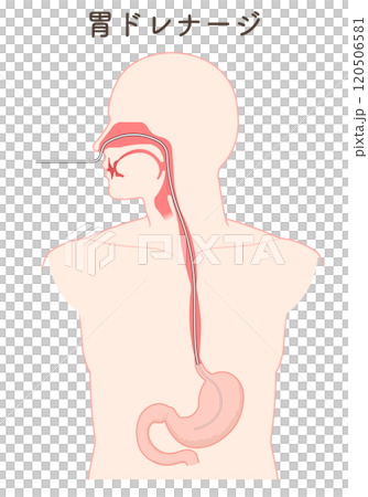 Gastric drainage, nasogastric tube 120506581