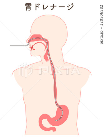 胃ドレナージ、Nasogastric tube 胃ドレナージ、Nasogastric tube 120506582