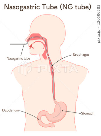 胃ドレナージ、Nasogastric tube 120506583