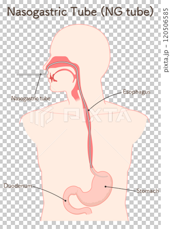 Gastric drainage, nasogastric tube 120506585