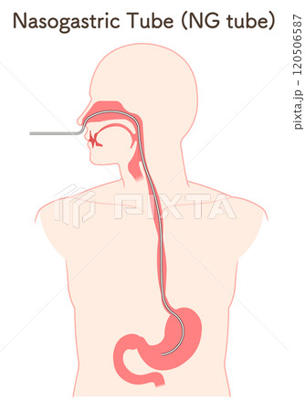 胃ドレナージ、Nasogastric tube 120506587