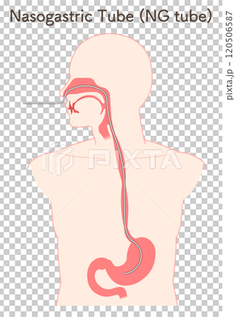 胃ドレナージ、Nasogastric tube 120506587