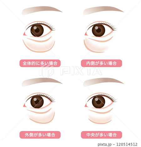 目の下のたるみ　たるんだ下まぶた　タイプ 120514512