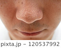 いちご鼻のクローズアップ：30代男性の毛穴と角栓 120537992