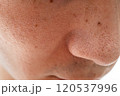 いちご鼻のクローズアップ：30代男性の毛穴と角栓 120537996