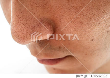 いちご鼻のクローズアップ:30代男性の毛穴と角栓 いちご鼻のクローズアップ:30代男性の毛穴と角栓 120537997