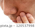 いちご鼻のクローズアップ：30代男性の毛穴と角栓 120537998