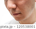 いちご鼻のクローズアップ：30代男性の毛穴と角栓 120538001