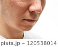 いちご鼻のクローズアップ：30代男性の毛穴と角栓 120538014