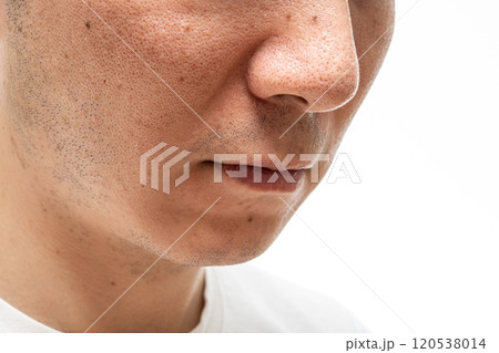 いちご鼻のクローズアップ:30代男性の毛穴と角栓 いちご鼻のクローズアップ:30代男性の毛穴と角栓 120538014
