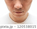 いちご鼻のクローズアップ：30代男性の毛穴と角栓 120538015