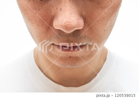 いちご鼻のクローズアップ:30代男性の毛穴と角栓 いちご鼻のクローズアップ:30代男性の毛穴と角栓 120538015