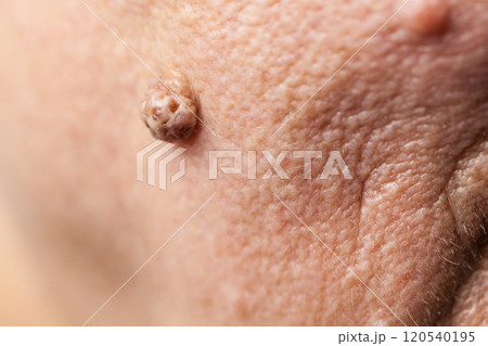 Elderly pensioner female, dermal fibroma closeup. Elderly pensioner female, dermal fibroma closeup. 120540195