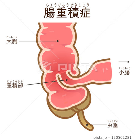 腸重積症、Intussusception、イラスト 120561281