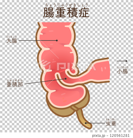 腸重積症、Intussusception、イラスト 120561281